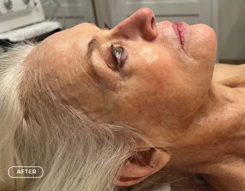 Haut nach der Anti-Aging-Behandlung