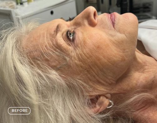Haut vor der Anti-Aging-Behandlung