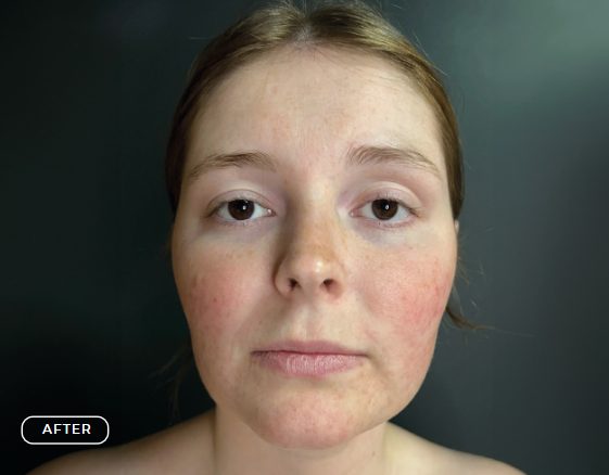Haut nach dem Oxygen RX Treatment mit Enzym-Peeling