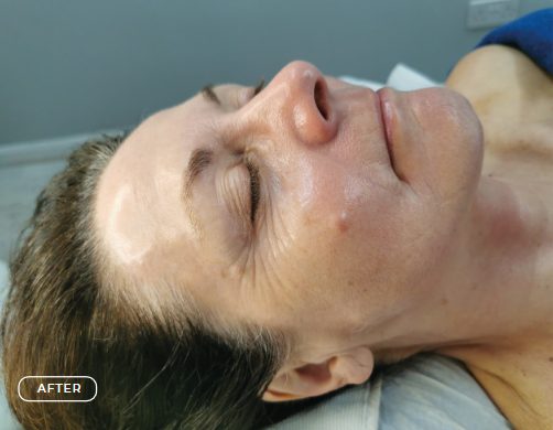 Haut nach dem SWiCH Treatment