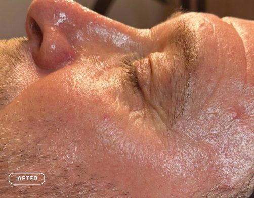 Haut nach SWiCH Treatment und Microneedling