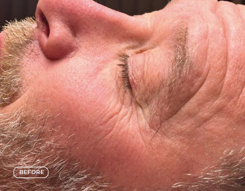 Haut vor SWiCH Treatment und Microneedling