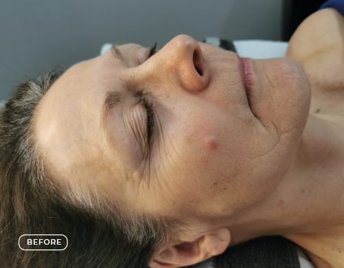 Haut vor dem SWiCH Treatment